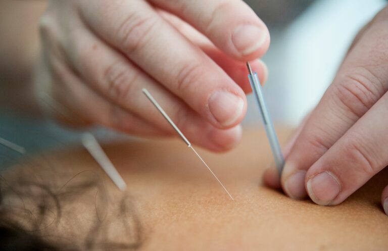 Acupuncture Therapy (আকুপাংচার)