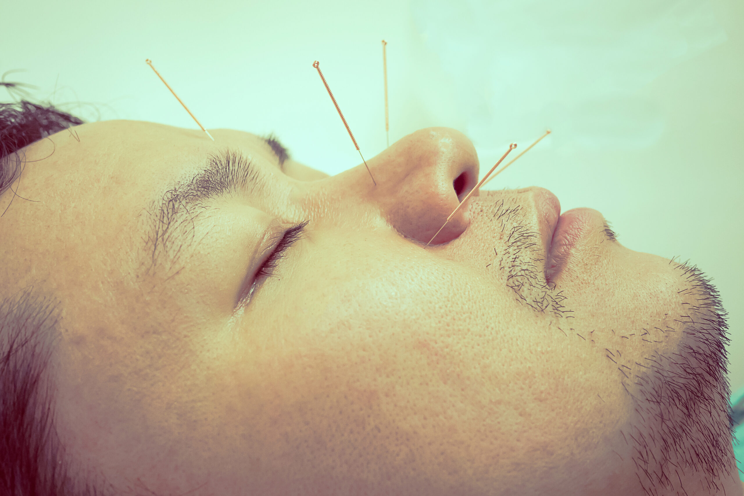 Acupuncture Therapy (আকুপাংচার)