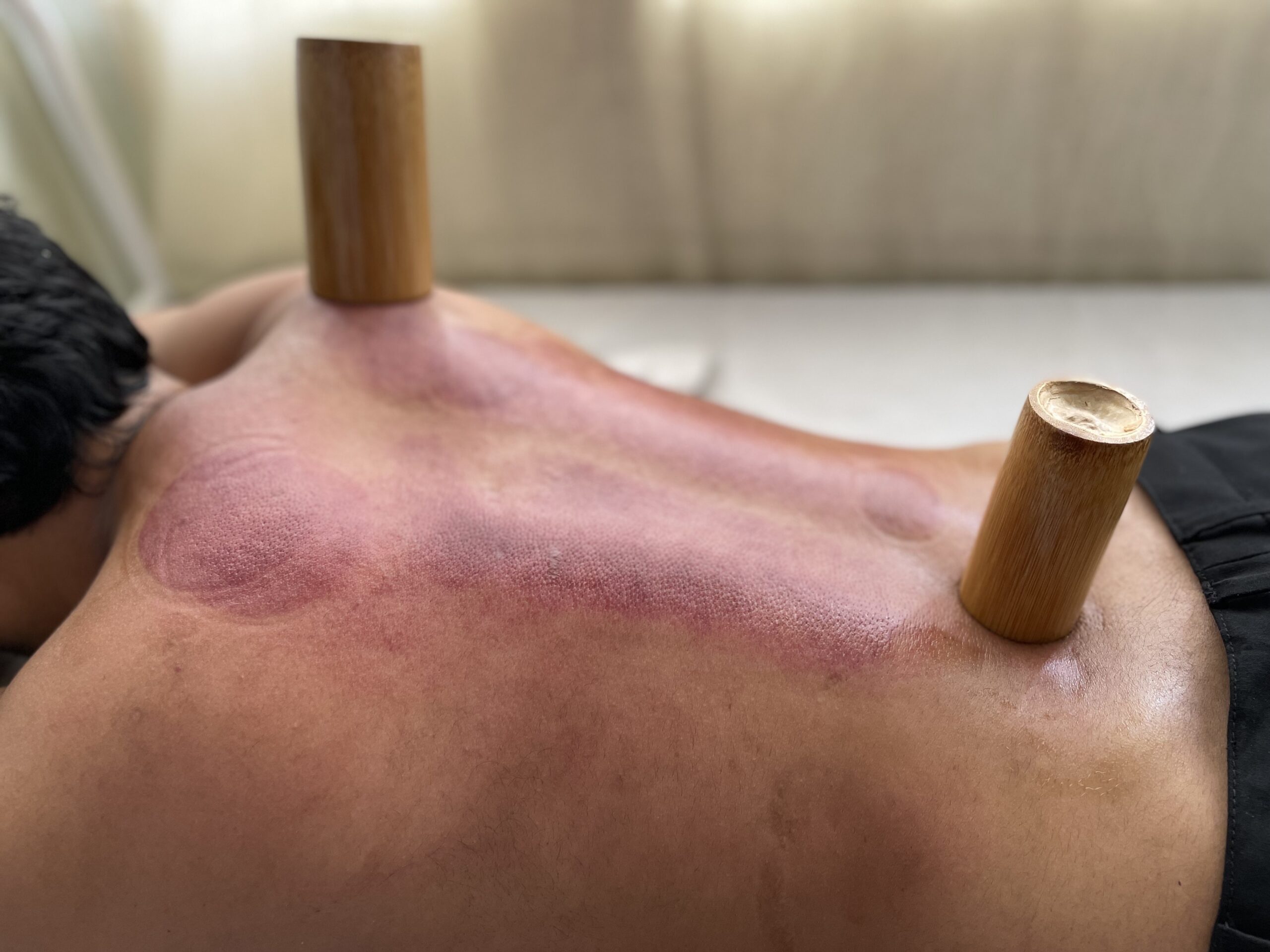 Cupping & Hijama Therapy (হিজামা এবং কাপিং থেরাপি)