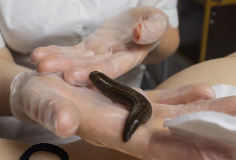 Leech Therapy (Jalaukavacharana) / লিচ বা জোঁক থেরাপি
