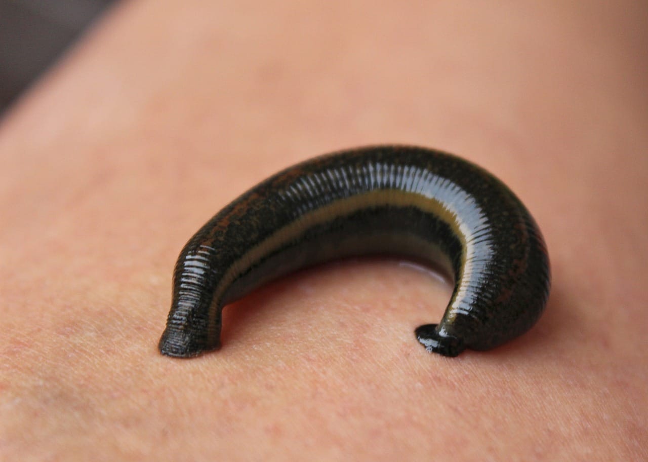 Leech Therapy (Jalaukavacharana) / লিচ বা জোঁক থেরাপি